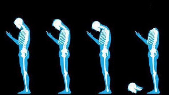 Text Neck Is Real Text Neck Is Real
