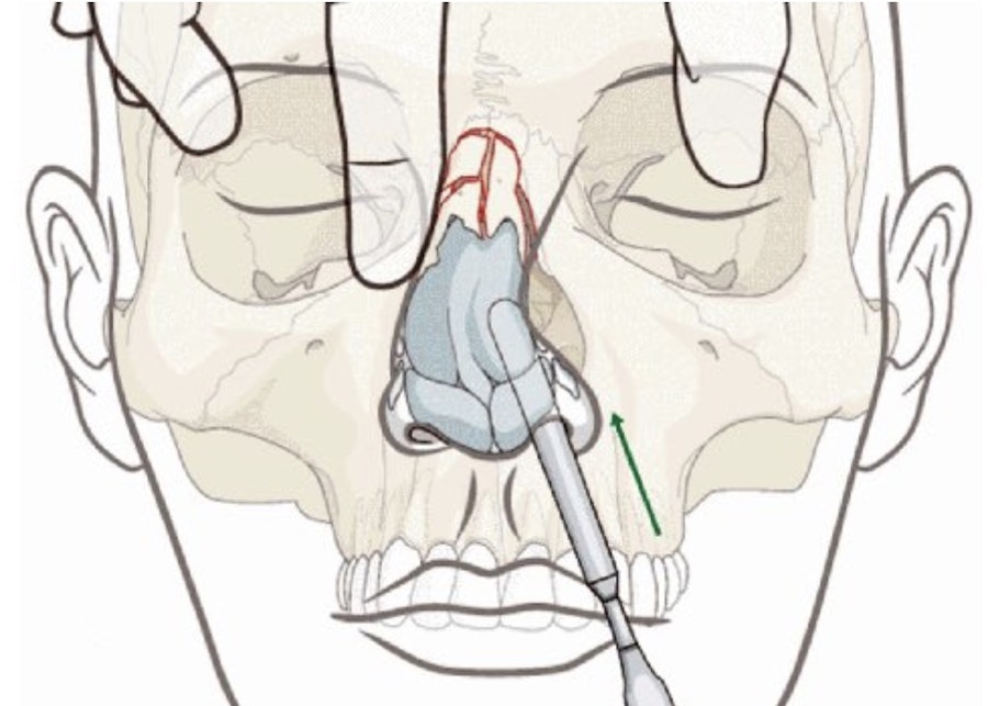 Перелом костей носа. Репозиция отломков костей носа. Перелом костей носа репозиция. Операция репозиция костей носа. Закрытый перелом костей носа со смещением отломков.